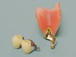 マルチコン・奥歯のアタッチメント式入れ歯